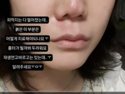 고은아 빙판길 넘어져 얼굴 피멍 근황에 안타까움